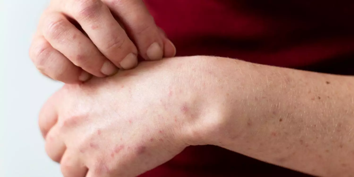 Sesma e Sespa reforçam que não há surto de Mpox no Pará